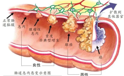 息肉變腸癌，這項(xiàng)檢查很重要→