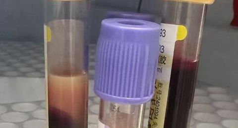 高脂血癥：不可忽視的健康威脅