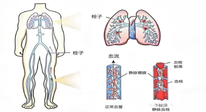 胸悶難受，突然暈厥，竟是肺被“栓”住了