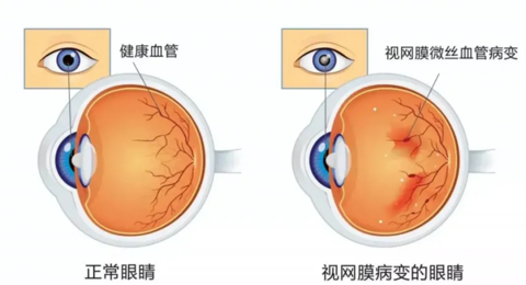 糖尿病會(huì)致盲！糖尿病患者需定期眼底篩查！